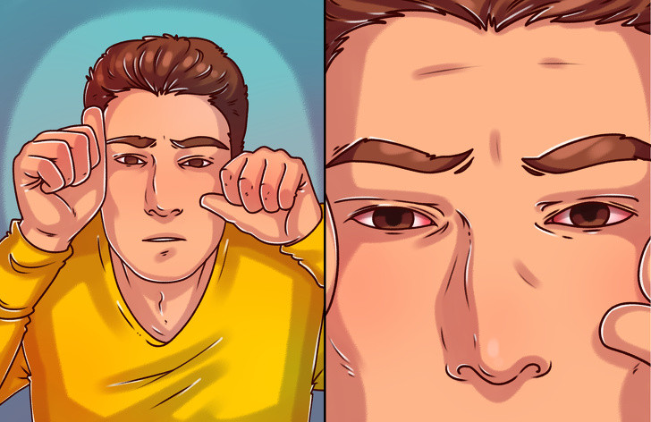 Khô mắt: Vitamin A cũng là thành phần cấu tạo và giúp màn nước mắt dính được vào bề mặt giác mạc. Thiếu vitamin A không chỉ gây quáng gà mà còn tăng sản sinh các tế bào vảy gây sừng hóa bề mặt, làm tổn thương và mất ổn định màn nước mắt, từ đó gây khô mắt. Nếu không điều trị kịp thời sẽ dẫn đến hậu quả mất thị lực vĩnh viễn.