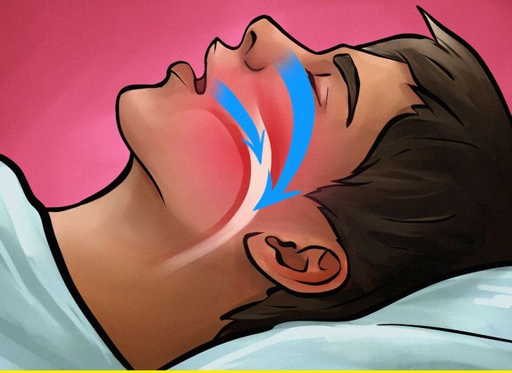 Giấc ngủ bị xáo trộn vì chứng ngưng thở khi ngủ: Ngưng thở khi ngủ là một loại rối loạn giấc ngủ mà người bệnh có những cơn ngưng thở hoàn toàn trong ít nhất 10 lần trong giấc ngủ và lặp đi lặp lại nhiều lần trong đêm. Do đó, giấc ngủ bị xáo trộn nhiều lần mỗi đêm và chúng ta cần ngủ nhiều giờ hơn để cảm thấy được nghỉ ngơi.