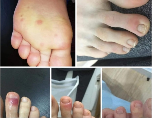 “Ngon chan COVID”, trieu chung la o benh nhan nhiem SARS-CoV-2