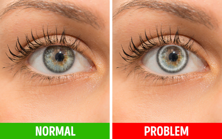 Thay đổi màu mắt: Nếu có một vòng trắng hoặc xám quanh giác mạc, đó có thể là dấu hiệu của cholesterol cao đối với những người dưới 45 tuổi. Thay đổi này thường vô hại và nó chỉ gây hiệu ứng hình ảnh.