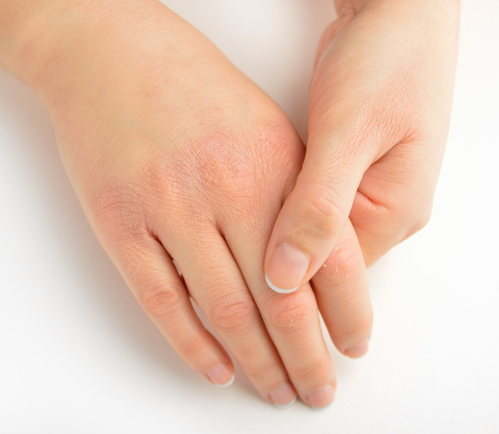 Làn da sưng dày ngứa: Đừng bỏ qua các dấu hiệu lạ về da hoặc đánh giá thấp chúng. Khi làn da trở nên dày và ngứa, đó có thể là dấu hiệu của một loạt các vấn đề bên trong như rối loạn nội tiết tố, bệnh chàm hoặc dị ứng. Bạn nên một số xét nghiệm máu nếu vấn đề này không thuyên giảm hoặc trở nên tồi tệ hơn.