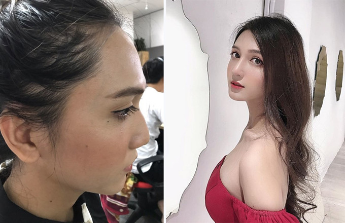 Hoàng Học đã chi khoảng 50 triệu đồng để nâng mũi, giúp gương mặt thanh thoát hơn.