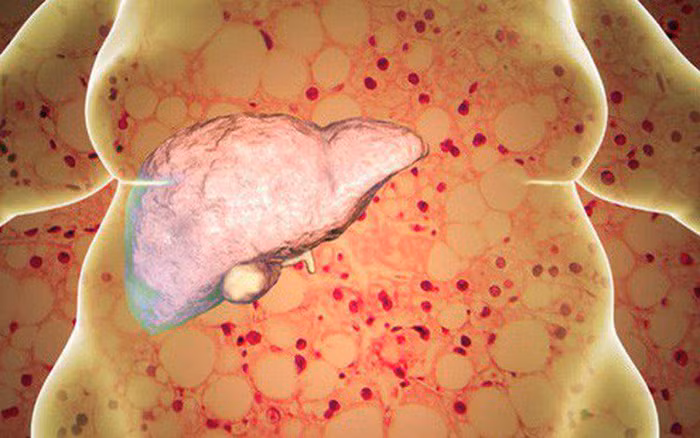 Bé trai mới 8 tuổi bị gan nhiễm mỡ: Cách phòng bệnh cho trẻ em Be trai moi 8 tuoi bi gan nhiem mo: Cach phong benh cho tre em