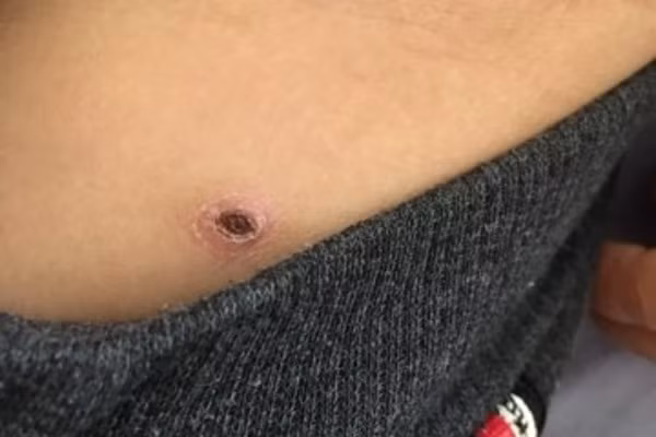 Sot mo nguy hiem ra sao khien 2 be nguy kich, tran dich phoi