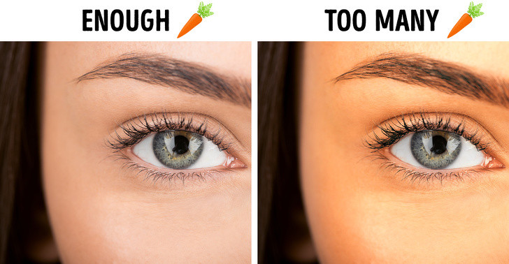 Cà rốt: Thực phẩm lành mạnh này rất giàu beta-carotene, vitamin A tốt cho cơ thể. Nhưng thật không may, nếu có quá nhiều lượng beta-carotene dư thừa trong cơ thể bạn có thể gặp chứng “caroten máu”, một căn bệnh khiến cho làn da của bàn trở nên vàng hơn.