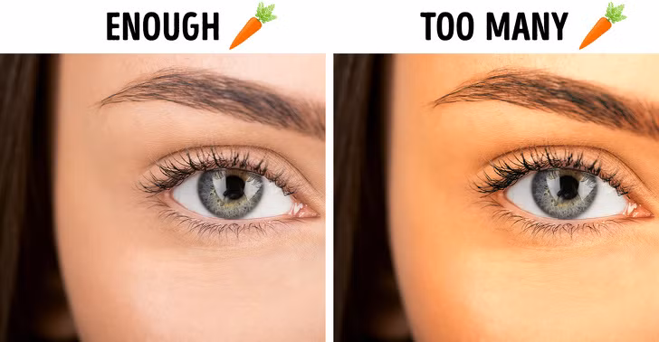 Cà rốt: Thực phẩm lành mạnh này rất giàu beta-carotene, vitamin A tốt cho cơ thể. Nhưng thật không may, nếu có quá nhiều lượng beta-carotene dư thừa trong cơ thể bạn có thể gặp chứng “caroten máu”, một căn bệnh khiến cho làn da của bàn trở nên vàng hơn.