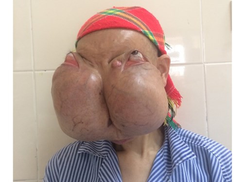 Mo cho benh nhan co hai khoi u khong lo tren mat-Hinh-3