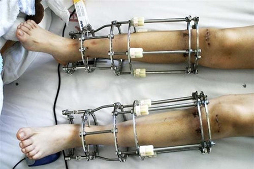 Sau khi cố định xương, cô gái phải nằm bất động 35-40 ngày. Đến khi tháo khung, chân vẫn luôn ở trong tình trạng rỉ máu. Nguyên lý của phương pháp kéo dài xương chân là cắt rời một chỗ trên đoạn xương chân cần kéo dài, xuyên các đinh chuyên dụng qua cả hai đoạn xương rời ra, rồi gắn vào một loại khung cố định đặc biệt ở bên ngoài chân.