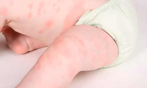 Loại sữa này được xem là chứa các protein ở dạng đơn giản nhất vì các amino axít là đơn vị cơ bản để tạo nên protein. Đây là loại được đề nghị nếu trẻ vẫn có dấu hiệu bị dị ứng sau khi dùng sữa đã qua xử lí protein.