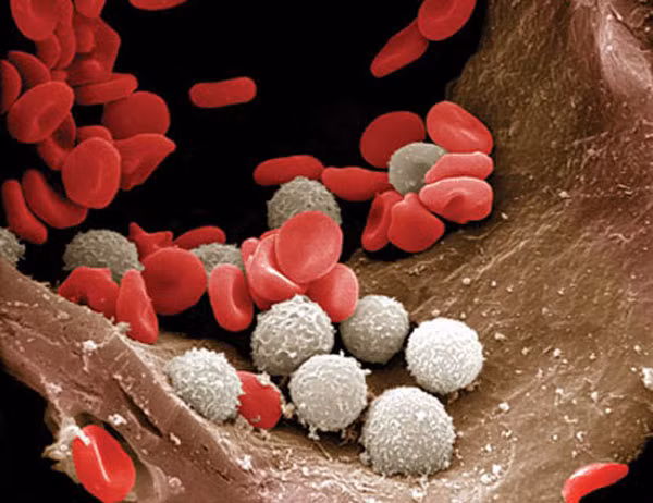 Bạch cầu vốn được sinh ra để bảo vệ cơ thể khỏi các tác nhân từ bên ngoài. Tuy nhiên khi lượng bạch cầu sản sinh quá nhiều sẽ dẫn đến tình trạng bạch cầu ăn hồng cầu. Hồng cầu sẽ bị phá hủy dần và người bệnh có dấu hiệu thiếu máu. Đây là căn bệnh ung thư ác tính không hình thành nên khối u.