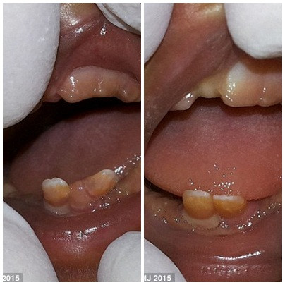 La lung be sinh doi moi chao doi da moc day rang