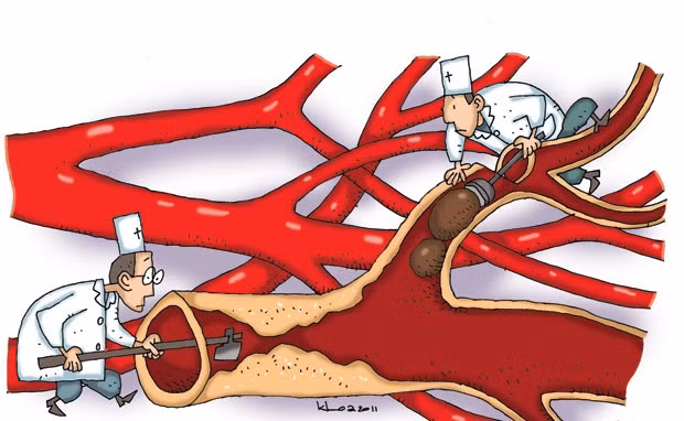 Thiểu năng tuần hoàn não. Là một trong những yếu tố gay đau đầu phổ biến khi ngủ trưa dậy. Có thể hiểu đơn giản hơn là bạn đang bị thiếu máu não làm cho giấc ngủ không sâu, thiếu khí gây đau đầu dữ dội sau khi dậy.