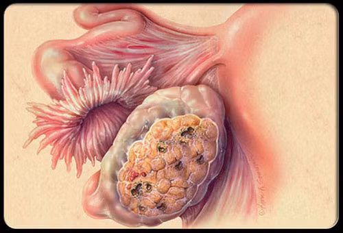 Mãi sau khi khám 3 lần bác sỹ gia đình vẫn khăng khăng mà bệnh không khỏi, bà khám ở chuyên gia của một bệnh viện và bác sĩ chẩn đoán cuối cùng đã xác định Humpage bị ung thư cổ tử cung. Tuy nhiên, nó đã quá muộn để cứu chữa và bà ấy đã chết 4 tháng sau đó.
