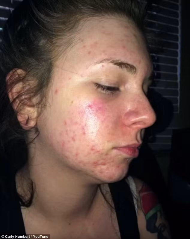 Bên cạnh mụn trứng cá, việc đặt vòng tránh thai còn khiến cô bị chứng đau nửa đầu triền miên. “Đó là cảm giác đau đớn và tồi tệ nhất mà tôi từng trải qua”, Carly Humbert chia sẻ.