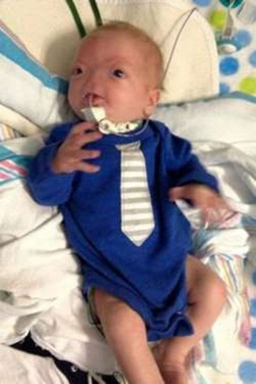 Bé Eli Thompson. Được sinh ra vào tháng 5/2015, em bé sơ sinh Thompson đã không có mũi và khoang mũi lẫn hệ thống khứu giác. Đánh bại dị tật không mũi vô cùng hiếm gặp, bé trai Eli Thompson vẫn là một thiên thần nhỏ khỏe mạnh và đáng yêu trong con mắt của mọi người.