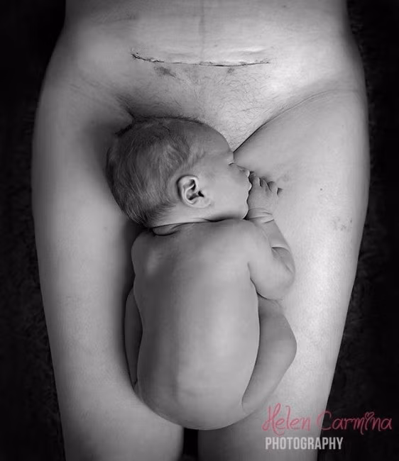 Bé bình yên nằm trên cơ thể mẹ, ngay cần vị trí em được sinh ra bằng phương pháp mổ đẻ.