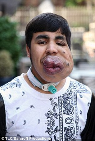 Chàng trai Zoubair Lahdohi đã phải sống 18 năm trong hình hài khuôn mặt dị dạng méo xệch, môi và lưỡi rơi ra ngoài và các mạch máu dưới da luôn căng hết cỡ.