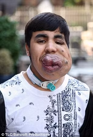 Chàng trai Zoubair Lahdohi đã phải sống 18 năm trong hình hài khuôn mặt dị dạng méo xệch, môi và lưỡi rơi ra ngoài và các mạch máu dưới da luôn căng hết cỡ.