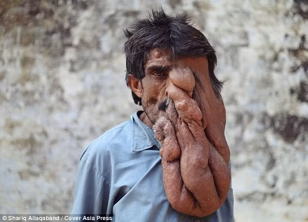 Anh Kanai Das ở Ấn Độ bị một tình trạng bệnh hiếm gặp gọi là u sợi thần kinh (neurofibromatonis) khiến khuôn mặt bị biến dạng, từng lớp da trên mặt của anh che lấp hẳn một bên mắt phải và chảy xuống tận ngực.