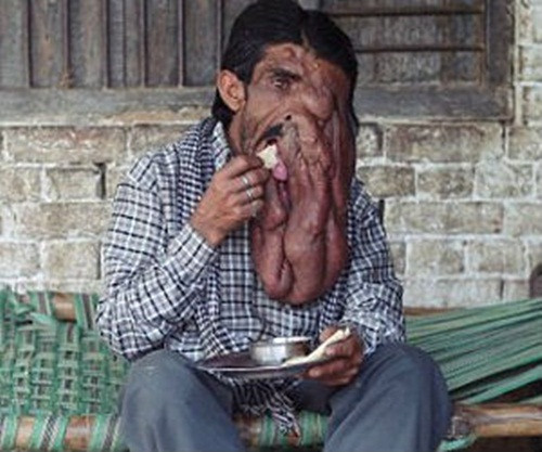 Căn bệnh này khiến anh khó khăn vật lộn với không chỉ những cơn đau mà còn bất tiện vô cùng trong sinh hoạt hàng ngày. Anh không thể ăn và phát âm được dễ dàng cũng như đánh răng là cả một cực hình.