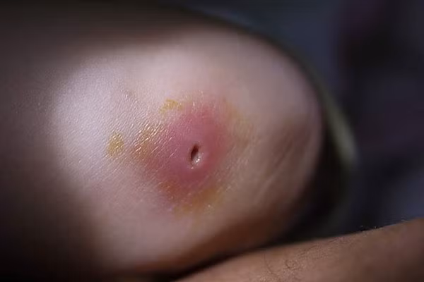 Chữa mụn nhọt : Bạn lấy thịt nhái bỏ ruột, sao đen, tán nhỏ, trộn với dầu vừng hay dầu lạc, đắp vào vết thương. Bài thuốc này giúp tiêu nhọt, giảm sưng rất tốt.