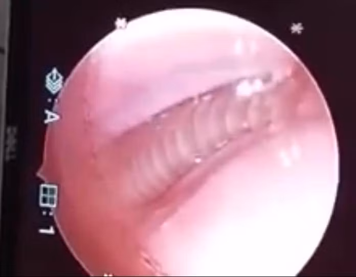 Be 1 tuoi bi dia chui vao mui khi di nghi resort