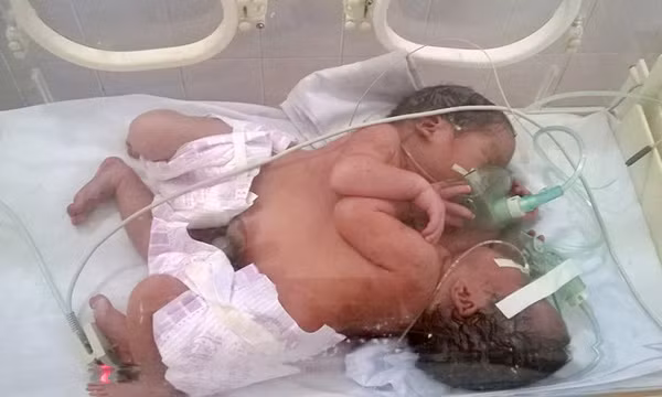 Cap song sinh dinh lien o Ha Giang da tu vong