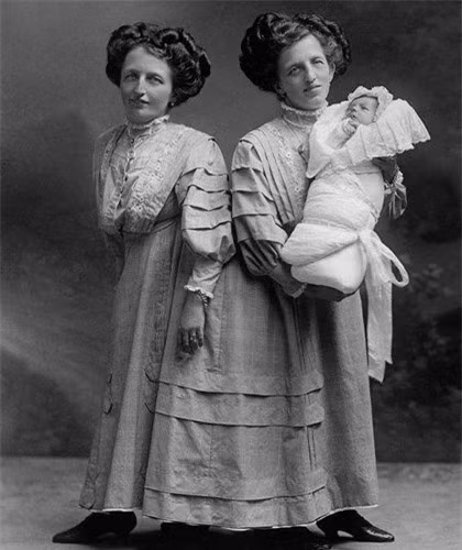 Rosa và Josepha Blazek - cặp song sinh người Bohemia, vào khoảng năm 1910, bị dị tật bẩm sinh có chung cơ thể.