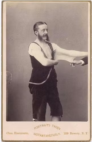 Felix Wehrle, được gọi là người "Đàn ông cao su". Bức hình chụp vào khoảng năm 1900. Felix mắc hội chứng Ehlers-Danlos cho phép kéo giãn làn da.