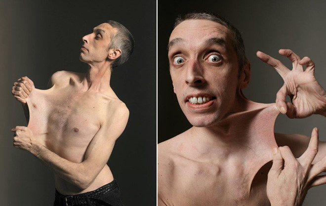 Bộ da co giãn nhất: Với phần da bụng có thể kéo ra thay khăn trải bàn, da cổ kéo lên che mặt, Garry Stretch Turner (Anh) là người có bộ da co giãn nhất thế giới. Mắc phải tình trạng y tế hiếm gặp gọi là hội chứng Ehlers-Danlos, Garry có thể kéo làn da của mình cách xa cơ thể tới 16 cm. Ảnh: Twitter.