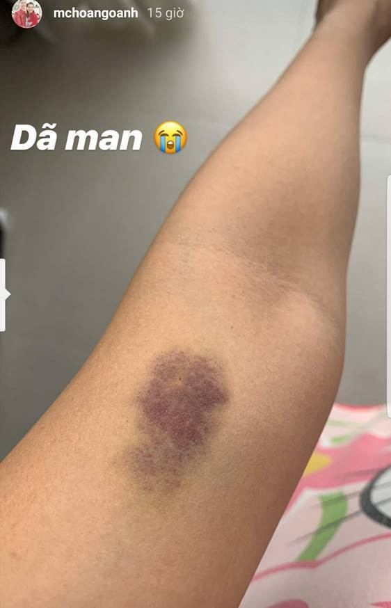 MC Hoàng Oanh chia sẻ hình ảnh vết bầm tím ở trên cánh tay. Tuy nhiên, nữ MC tài năng lại không cho biết nguyên nhân gây nên vết thương lại càng khiến cho người hâm mộ lo lắng và tò mò.