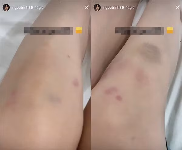 Thế nhưng gần đây, Ngọc Trinh bất ngờ để lộ đôi chân với những vết bầm tím khiến fan của cô không khỏi xót xa.