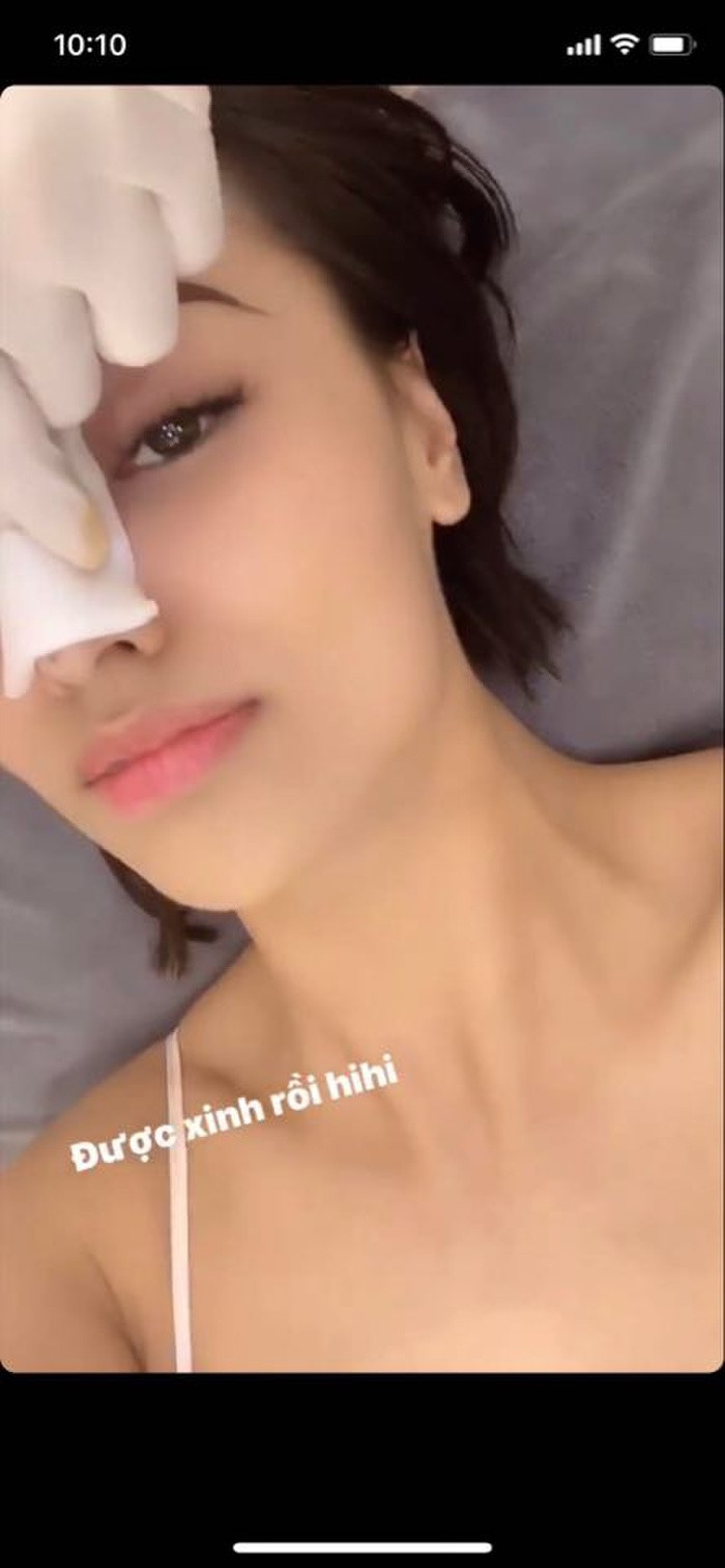 Dien mao cua Hong Que sau khi sua mui lan 2