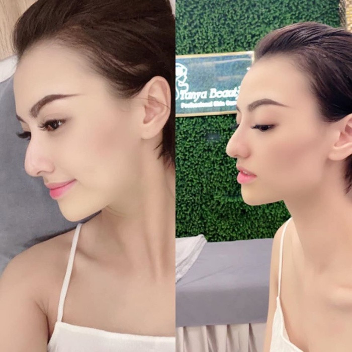 Dien mao cua Hong Que sau khi sua mui lan 2-Hinh-2