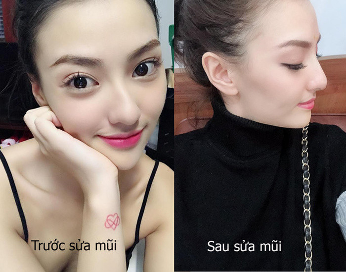 Dien mao cua Hong Que sau khi sua mui lan 2-Hinh-3