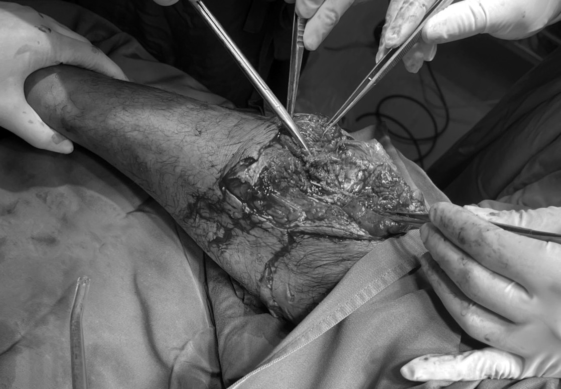 Người đàn ông bị cá mập cắn nguy kịch giờ ra sao? - Hình 2 Nguoi dan ong bi ca map can nguy kich gio ra sao?-Hinh-2