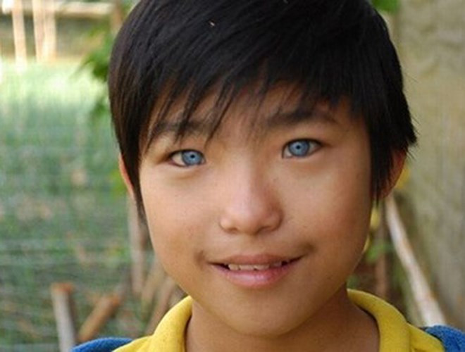 Cậu bé Nguyễn Văn Hào ở Đà Lạt sinh năm 1999 cũng sở hữu đôi mắt màu xanh nước biển khiến nhiều người ngỡ ngàng. Đôi mắt lạ khiến bé Hào gặp không ít phiền toái