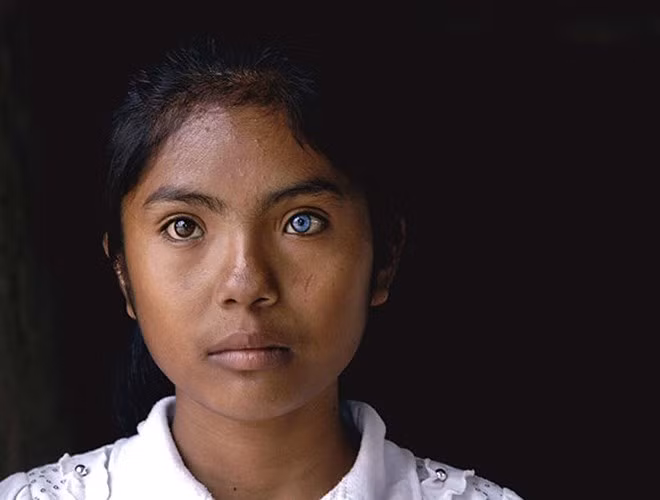 Được biết bố của Sa Pa có hai mắt màu xanh, còn mẹ em mắt đen bình thường. Riêng người anh trai của em có hai mắt màu xanh. Sa Pa cho biết, thị lực của em và mọi người trong nhà hoàn toàn bình thường không có gì khác mặc dù người ngoài nhìn vào có cảm giác như con mắt màu xanh có thể có vấn đề