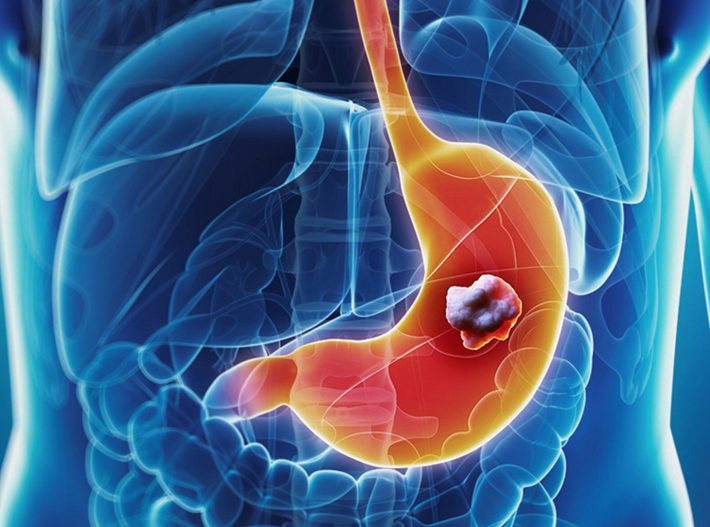 Trieu chung hiem gap o mat canh bao ung thu da day