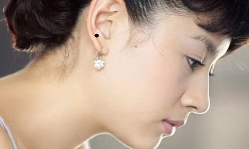 Boi chuan not ruoi vuong tai vuong van tren mat nu gioi