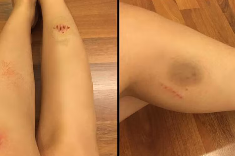 Loạt hình ảnh đóng phim đến nỗi trầy xước cơ thể của hot girl Elly Trần khiến nhiều người hâm mộ không khỏi xót xa.