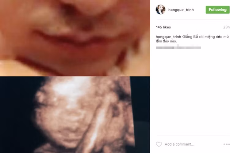 Mới đây, trên trang cá nhân Instagram, người mẫu Hồng Quế thích thú ghép hình ảnh siêu âm mới nhất của thai nhi trong bụng và một phần gương mặt của bạn trai.