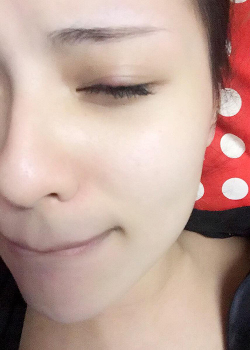 Hình ảnh Hồng Quế với bên mắt trái bị lên lẹo trong thời gian mang thai đứa con đầu lòng.