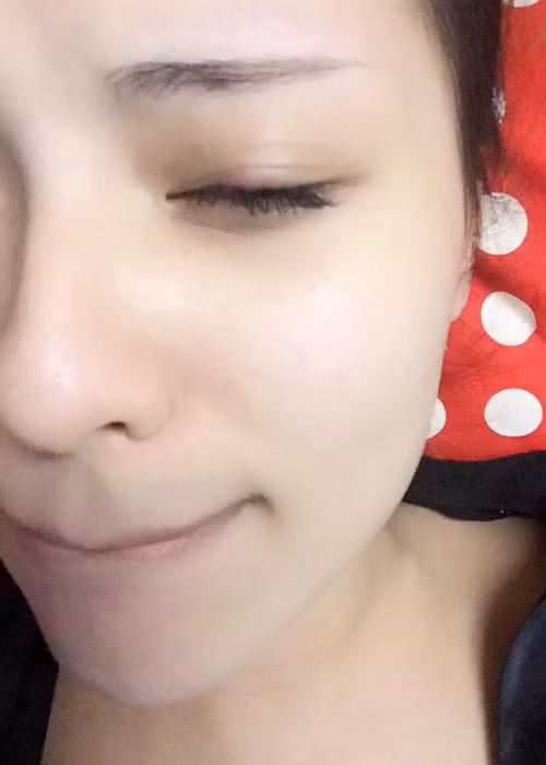 Hình ảnh Hồng Quế với bên mắt trái bị lên lẹo trong thời gian mang thai đứa con đầu lòng.