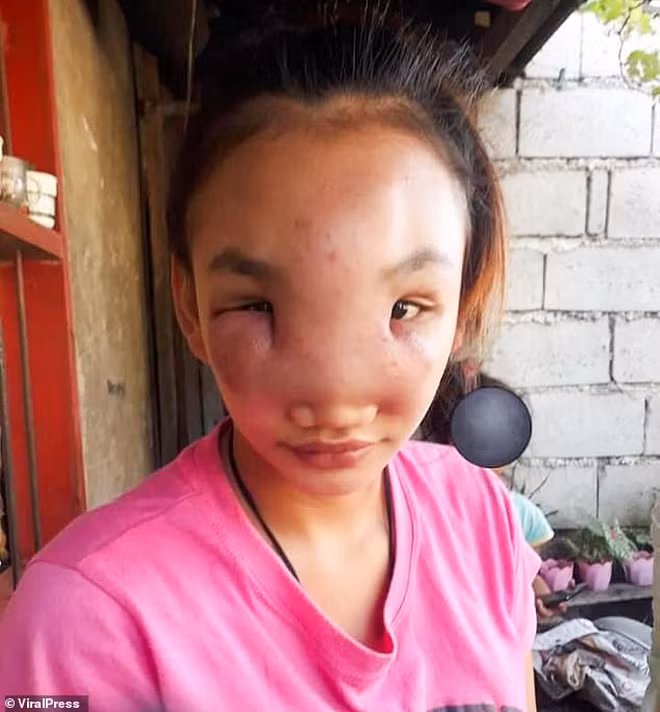 Nan mun mui, co gai mac benh la nguoi than cung nhan khong ra-Hinh-2