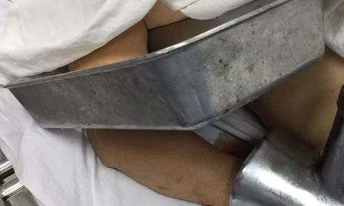 Mang ban tay bi ket trong may xay thit toi benh vien