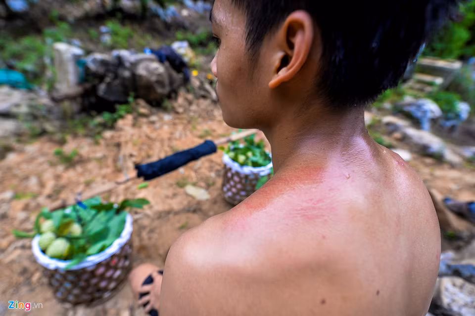 Đỗ Danh Quyền (sinh năm 2000) đã theo bố mẹ đi hái na từ 5 năm trước. Đôi vai em ửng đỏ sau mỗi gánh na nặng gần 50 kg.