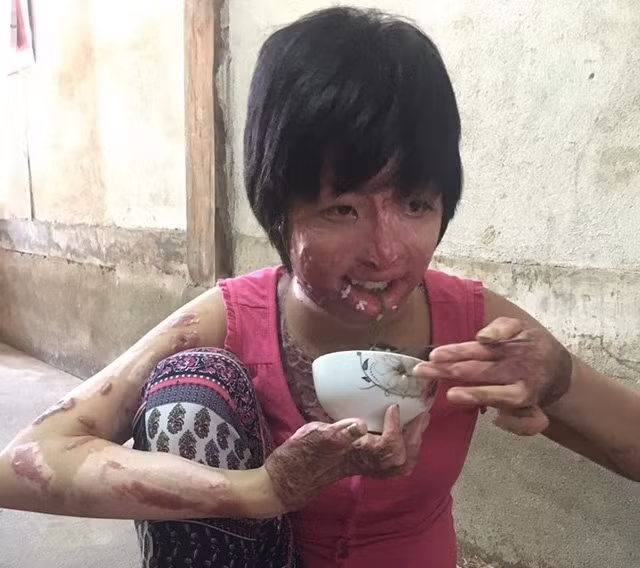 Mo uoc nho nhoi cua 9x song sot sau khi chong tuoi xang dot