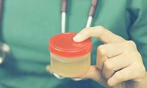 Nuoc tieu mau sam bao hieu benh gi?