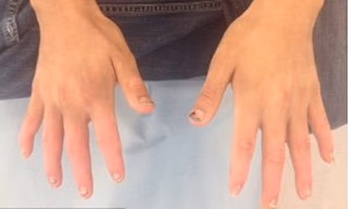 Thanh nien suyt phai cua tay vi ngu ngoai hien nha khi say ruou